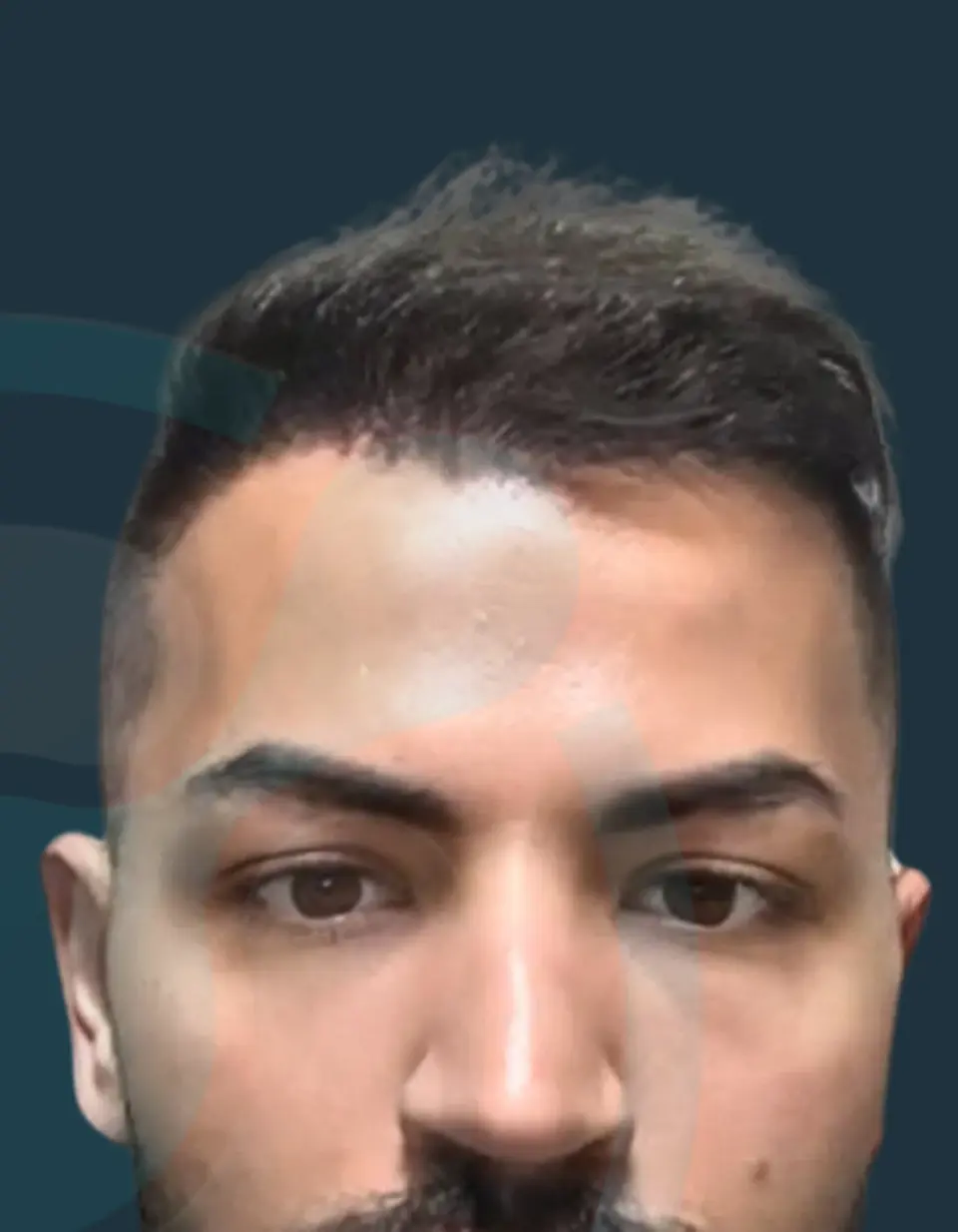 Beard Transplant