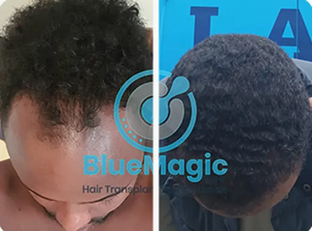 Before / After: Afro hair, hairline
