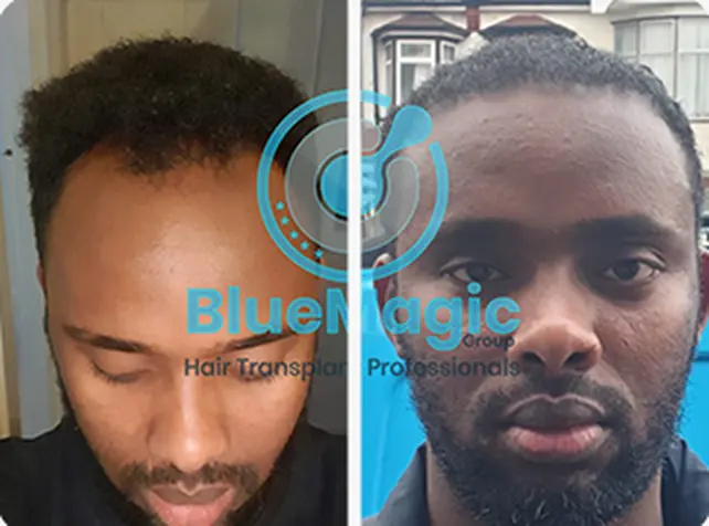 Before / After: Afro hair, density