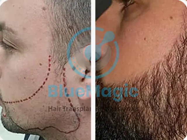 Before / After: Beard, density and shape