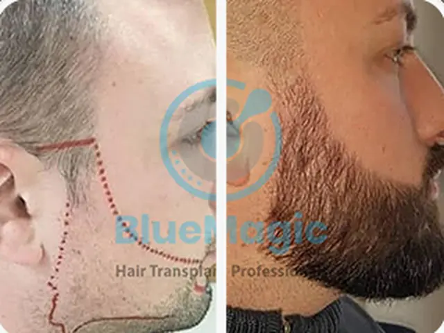 Before / After: Beard, full design