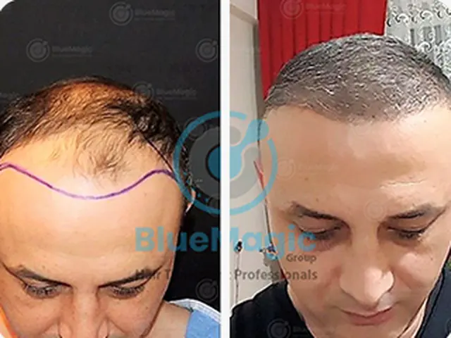 Before / After: Crown restoration
