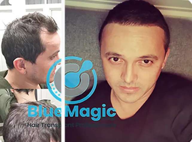 Before / After: Hairline, DHI