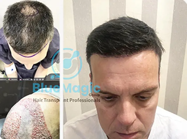 Before / After: Crown and hairline, DHI