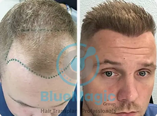 Before / After: Hairline, manual FUE