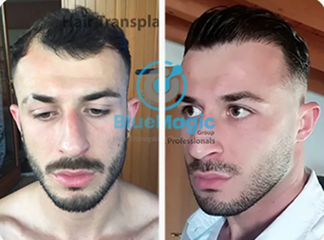 Before / After: Hairline, Sapphire FUE