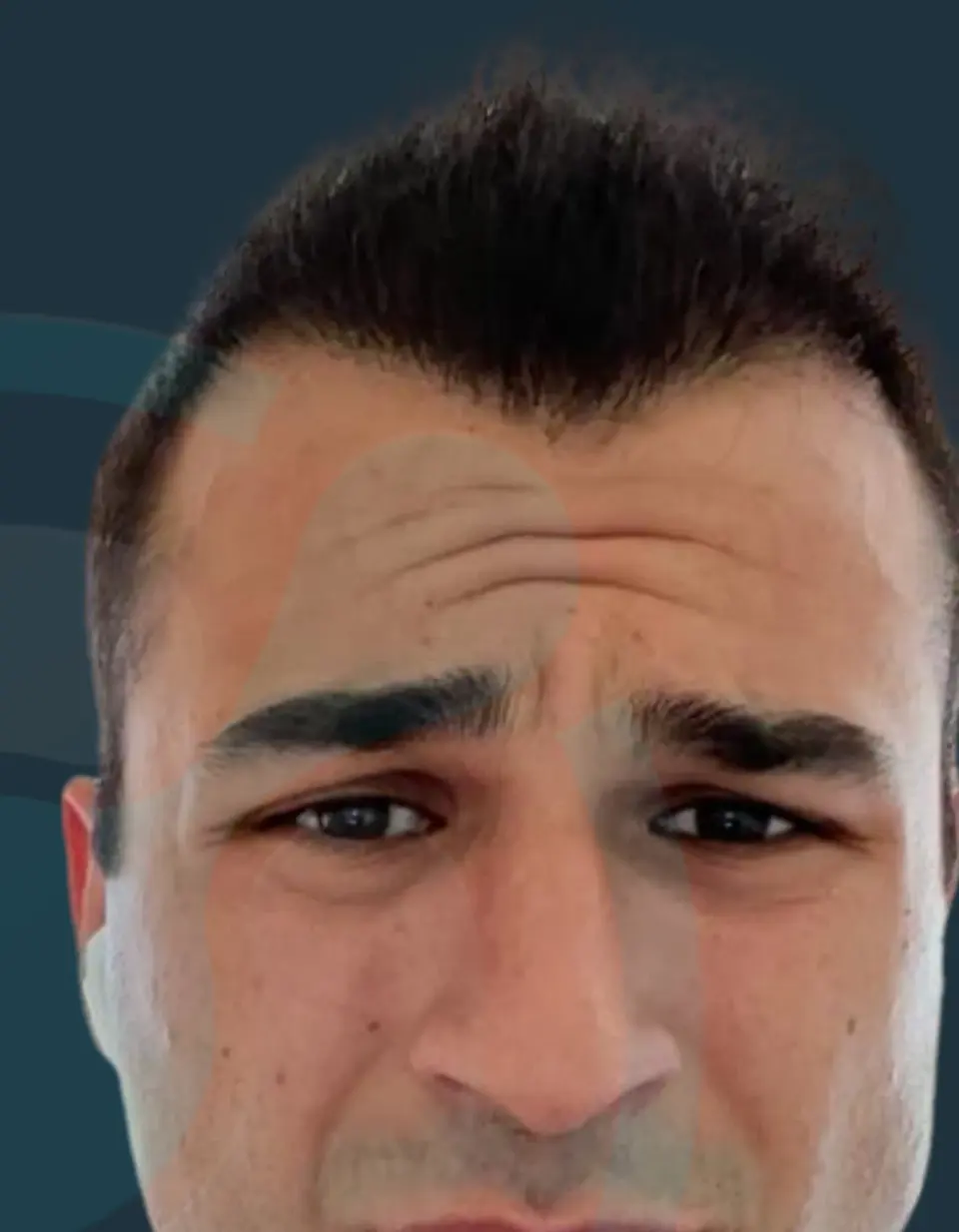 After: Hairline & density