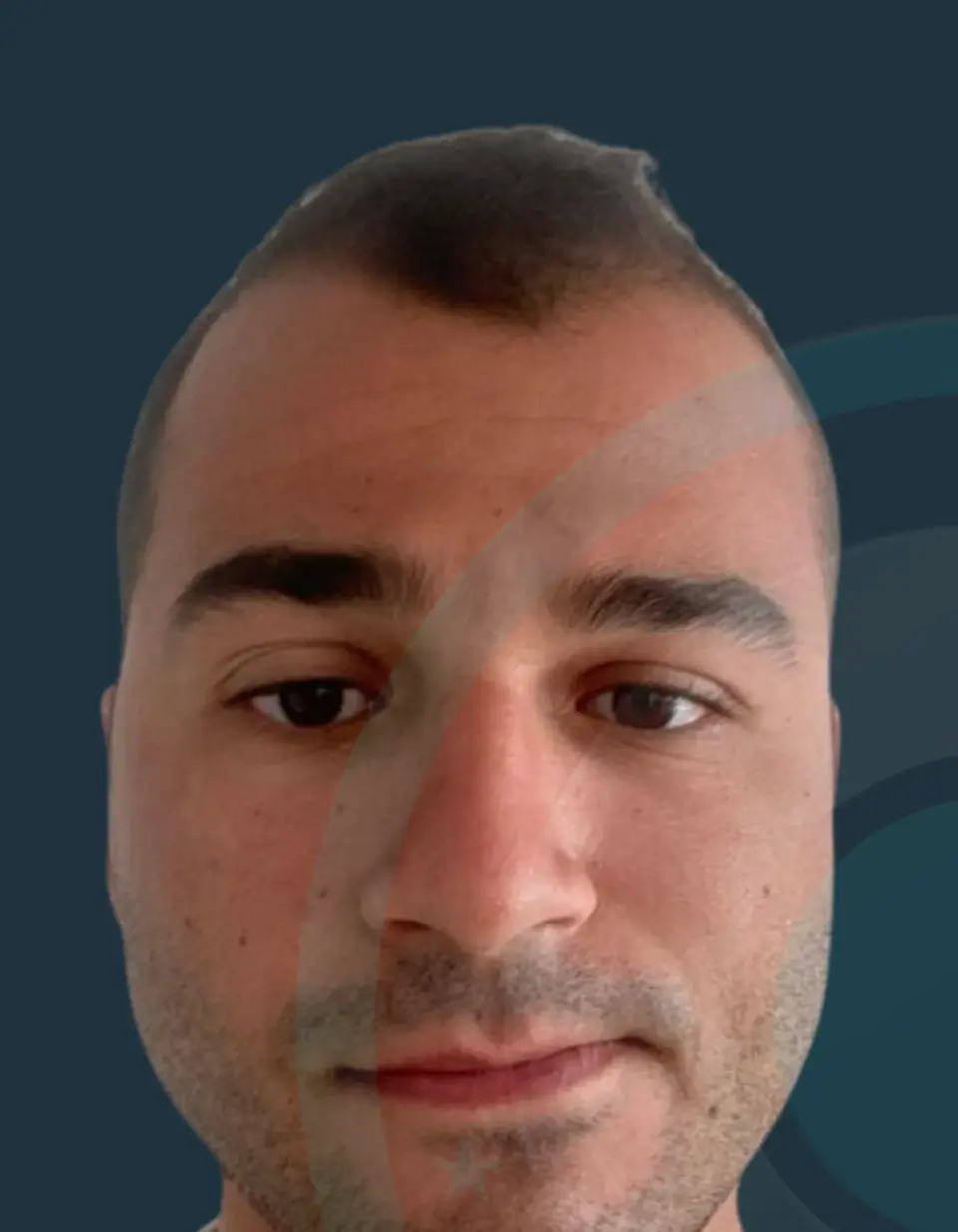 Before: Hairline & density