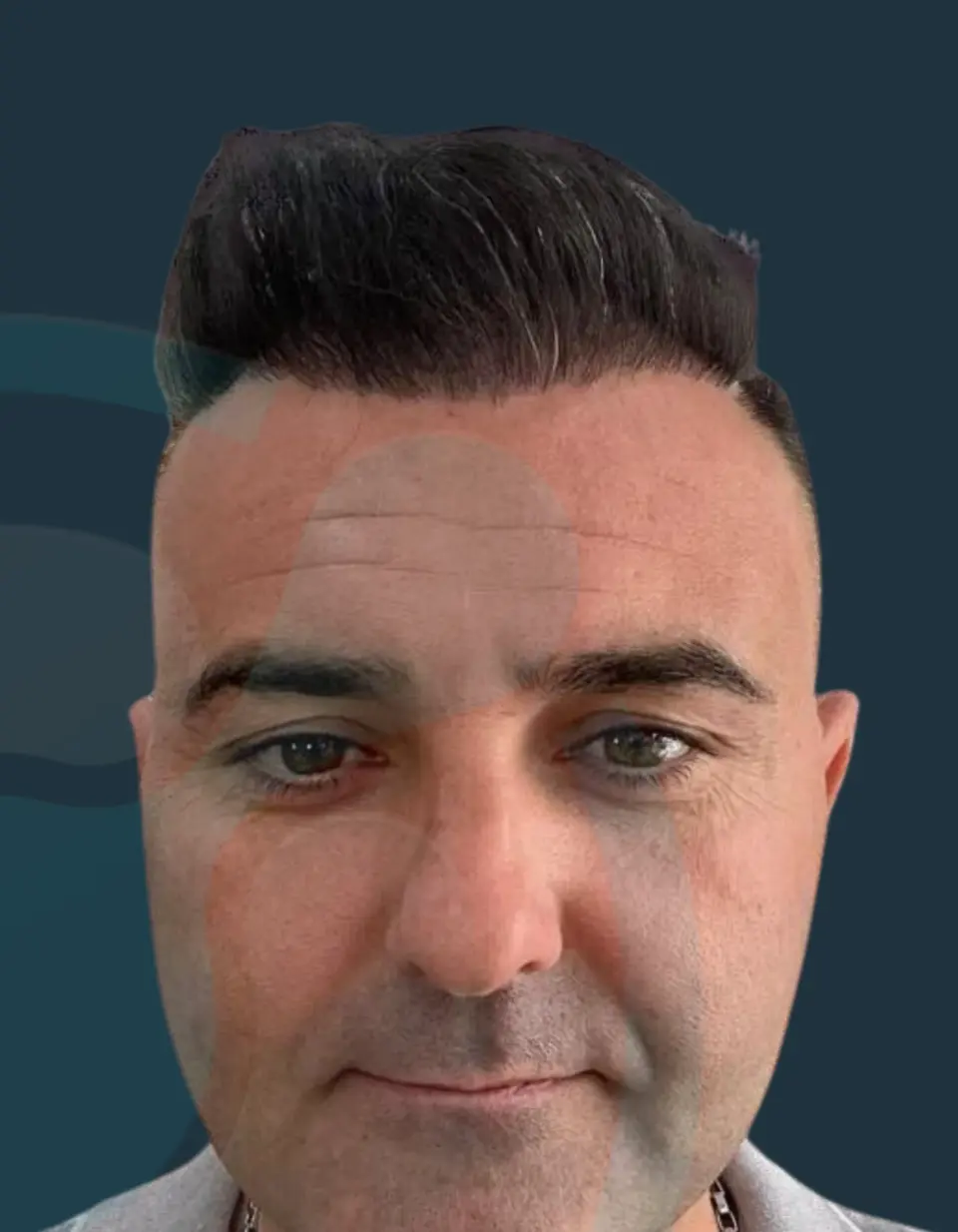 After: Hairline reconstruction