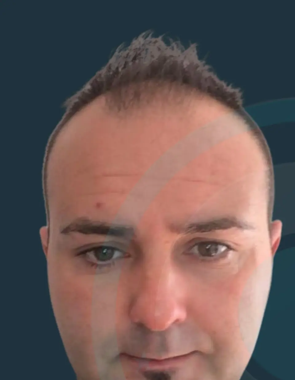 Before: Hairline reconstruction