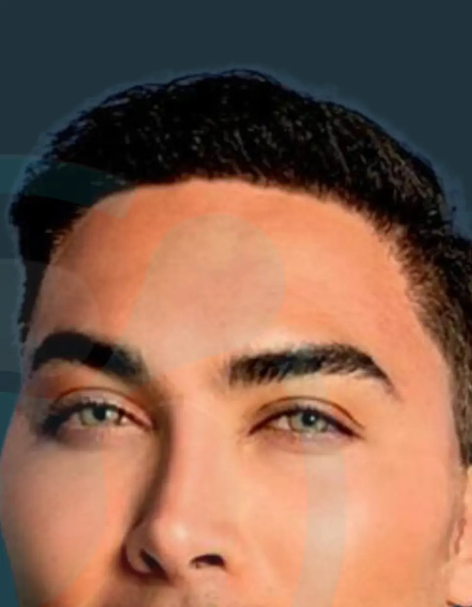 After: Hairline restoration