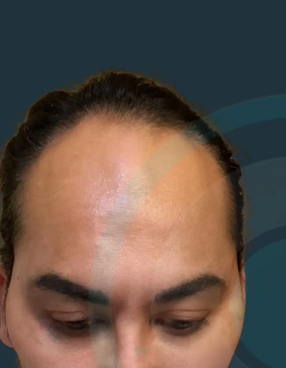 Before: Hairline restoration