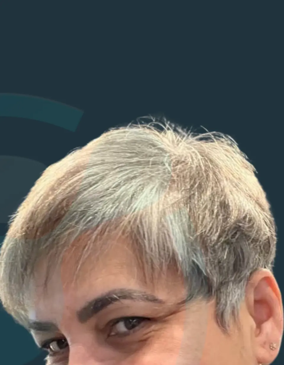 After: Female hair transplant