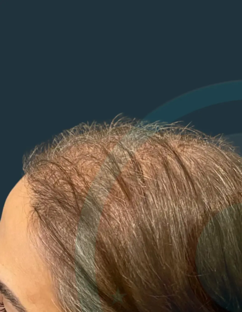 Before: Female hair transplant