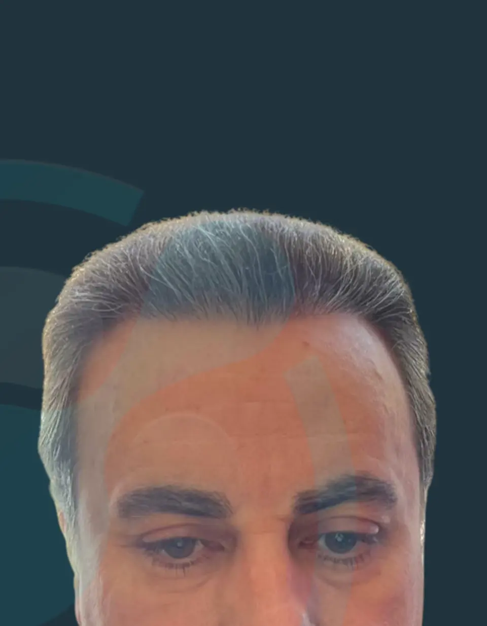After: Hairline & density