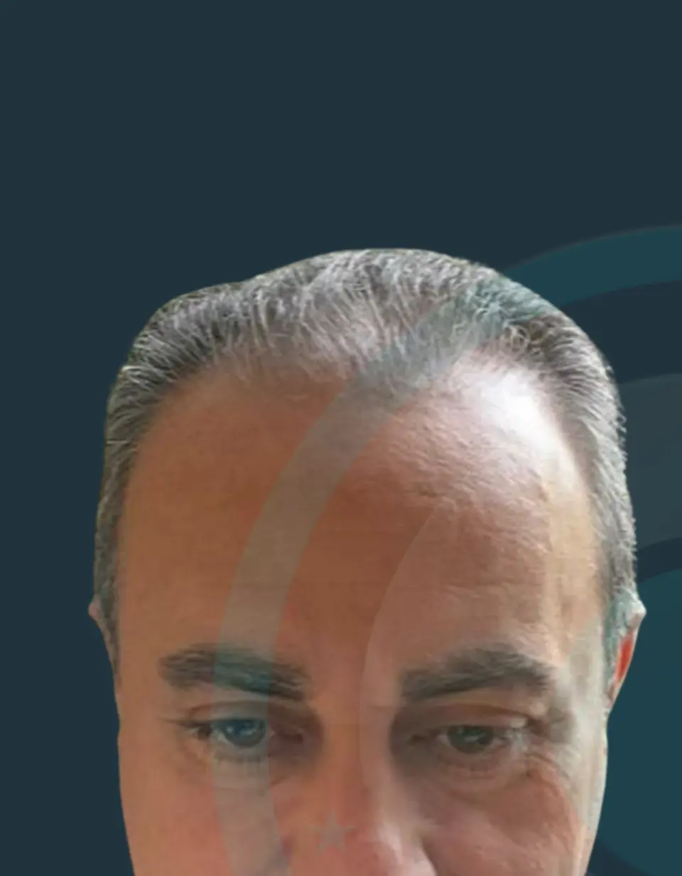 Before: Hairline & density