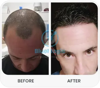 Before and after images showcasing the results of a hair transplant procedure performed by BlueMagic Group Clinic. The 'before' image highlights significant hair thinning and visible scalp, while the 'after' image demonstrates a successful restoration with fuller, natural-looking hair growth.