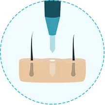 hair transplant Step