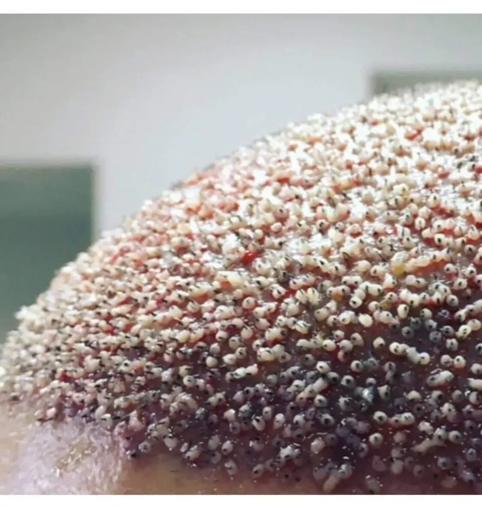 Educational image discussing common mistakes in poorly performed hair transplants, emphasizing the importance of choosing experienced clinics like BlueMagic Group
