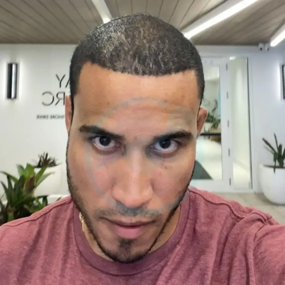 Hector Acosta hair transplant