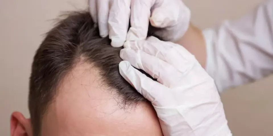 Hair Transplant