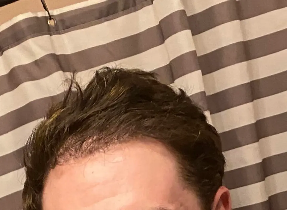 Patient showcasing their restored hairline post-transplant surgery performed by BlueMagic Group, emphasizing natural-looking results.