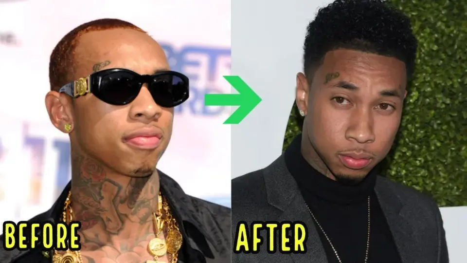 Celebrity Tyga displaying his restored hairline after undergoing an advanced hair transplant procedure at BlueMagic Group.