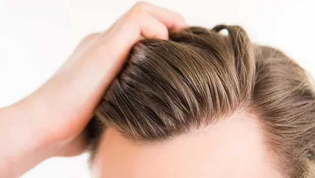 Close-up of transplanted hair follicles after surgery, showing precise alignment and healthy growth achieved through advanced techniques at BlueMagic Group.