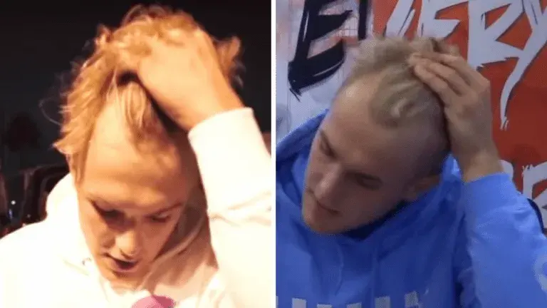 Before and after images of Jack Paul demonstrating significant improvement in scalp coverage after undergoing advanced transplantation techniques.