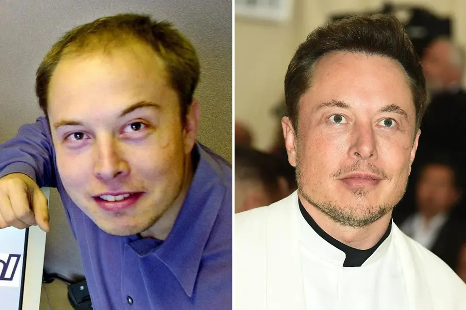 Before and after images of Elon Musk showcasing dramatic improvement in scalp coverage following a successful transplant procedure.