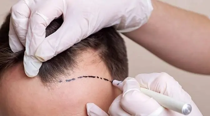 Surgeon marking hairline on a patient's scalp as preparation for a hair transplant procedure at BlueMagic Group.