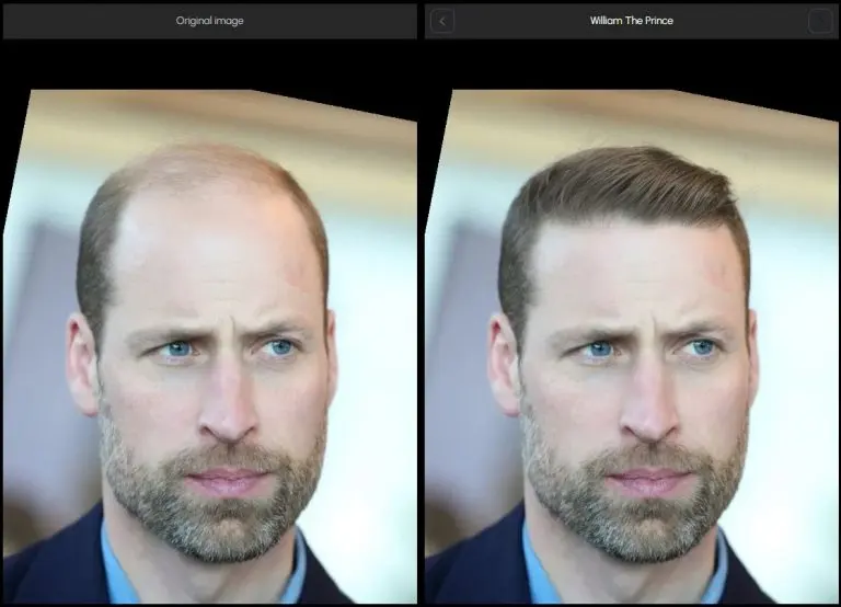 Before and after images of Prince William demonstrating significant improvement in scalp coverage after undergoing advanced transplantation techniques.