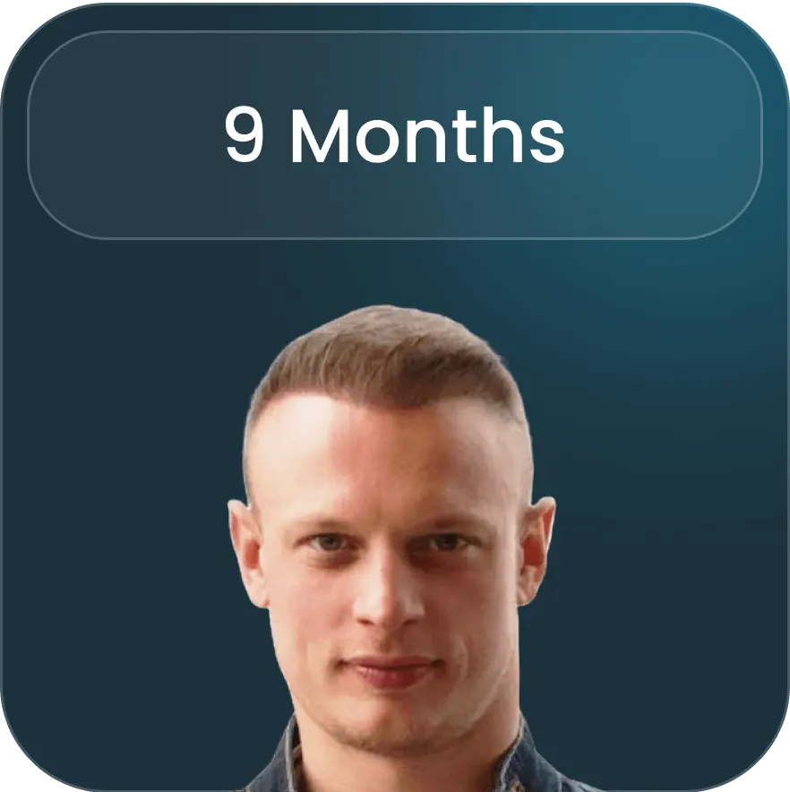 Image detailing post-operative care and recovery following a hair transplant at BlueMagic Group, emphasizing the importance of follow-up consultations.