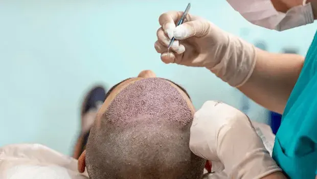 Graphic illustrating the benefits of advanced FUE Sapphire technique used by BlueMagic Group for natural and long-lasting results.