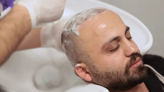 Hair wash process after hair transplant