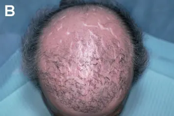 Before and after comparison showing dramatic improvement in hair density after a successful transplant procedure at BlueMagic Group