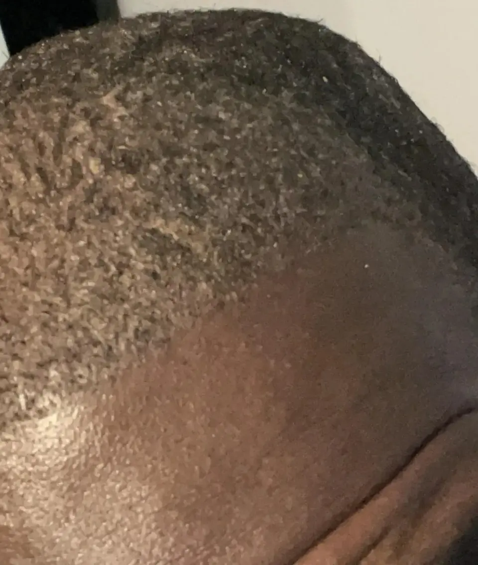 Close-up of a patient's scalp showing natural hair growth after a hair transplant procedure at BlueMagic Clinic.