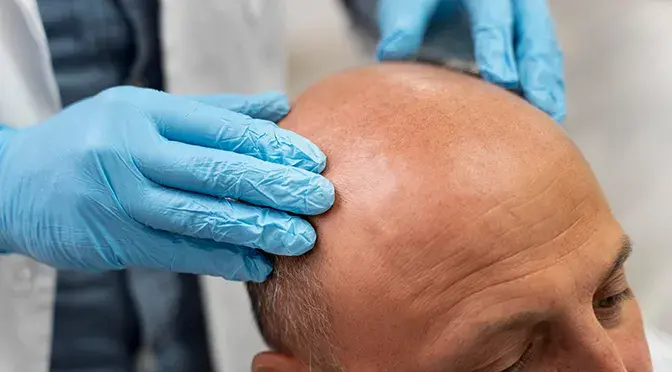 Image from BlueMagic Group’s blog showing a patient undergoing a detailed consultation for a personalized hair transplant plan.